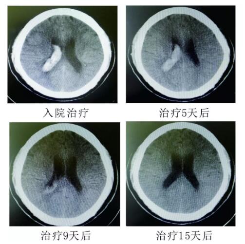 腦出血你不得不引起重視的疾病！?。?></a></div>
               
 					<div   id=