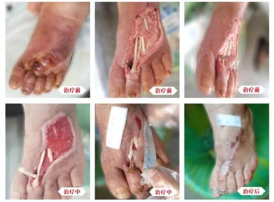 糖尿病并發(fā)癥有多可怕，及時治療糖尿病足避免截肢！