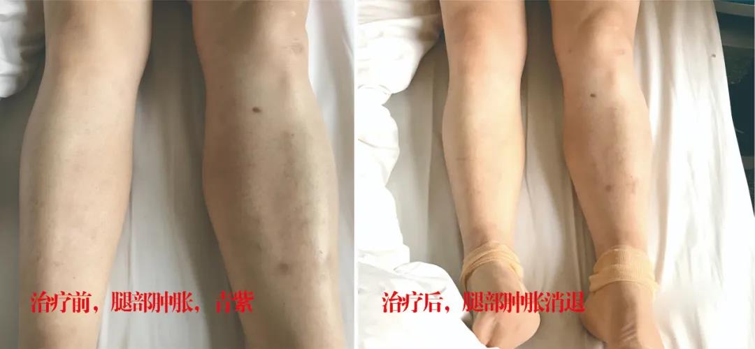 下肢靜脈血栓多年頑疾反復(fù)腫痛——疾病不容等待，早治療，早健康！