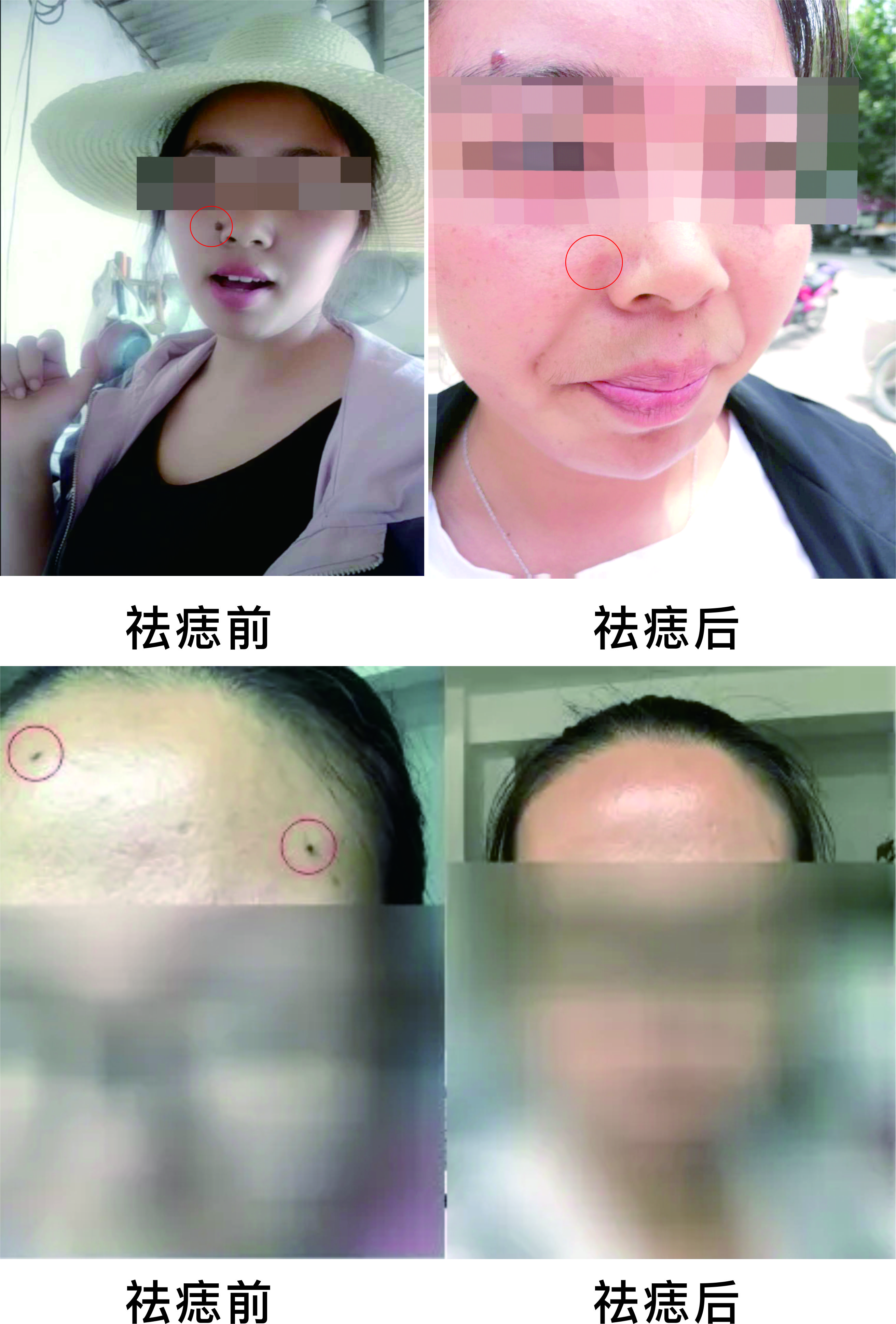 微波祛痣，告別臉部多余的“點(diǎn)綴”~