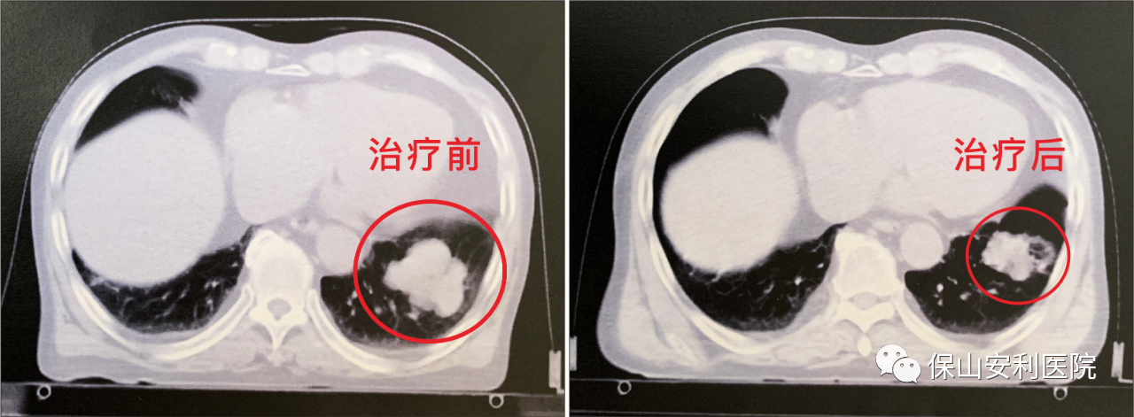 不做手術，早期肺癌也能根治！