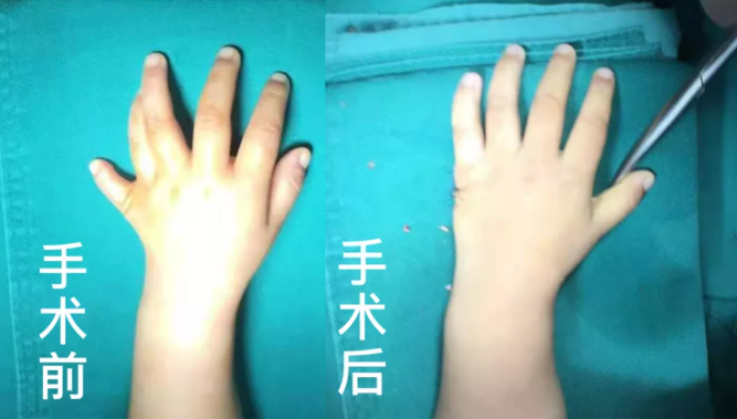【保山安利醫(yī)院】2歲小兒手、足多指（趾）成功修復(fù)(矯正）！