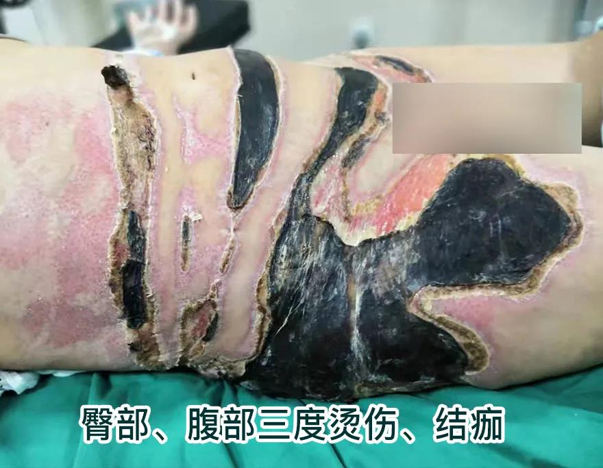 【保山安利醫(yī)院】80歲老人不慎燒傷，導致腹部、右側(cè)臀部大面積創(chuàng)傷，經(jīng)植皮治療創(chuàng)面逐漸愈合
