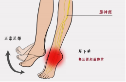 【保山安利醫(yī)院—健康科普】什么是足下垂！你了解嗎？