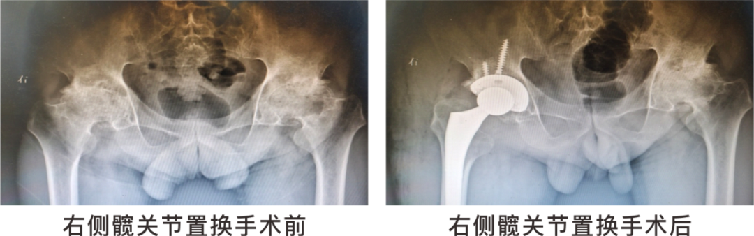【保山安利醫(yī)院】長期飲酒導(dǎo)致雙側(cè)股骨頭壞死，髖關(guān)節(jié)置換后重獲運動功能！